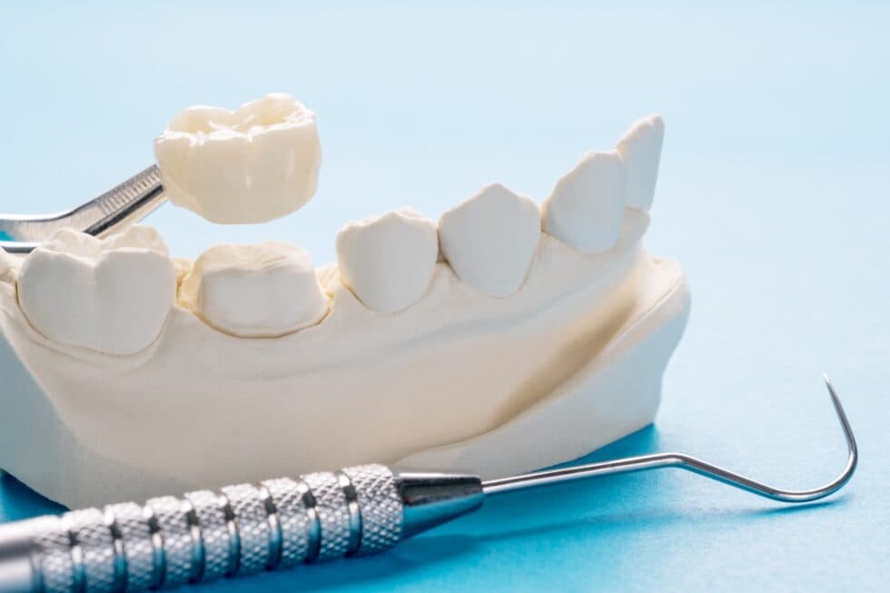 Crowns & Bridges: Reliable Solutions for Damaged Teeth