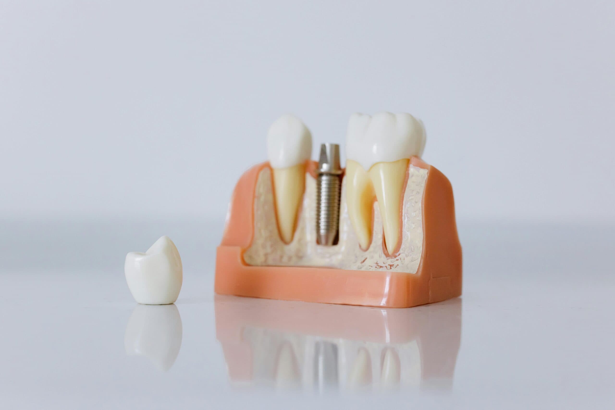 All-on-X Implant at BENE Dental