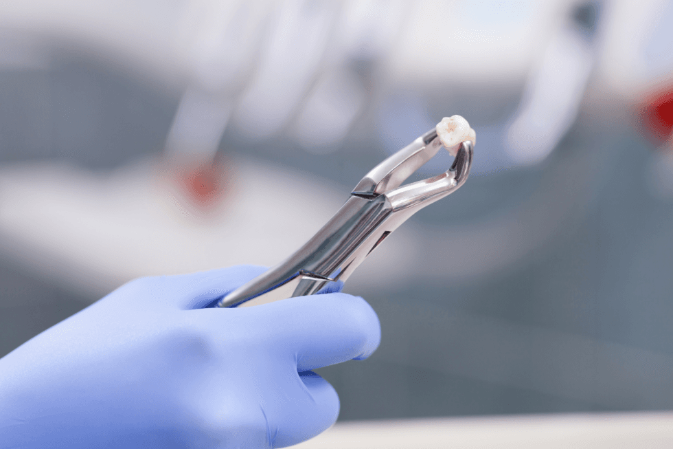 Tooth Extractions: When Removal Is the Best Choice